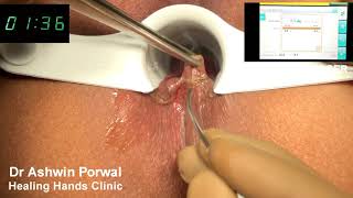 Laser Sphincterolysis in Anal Fissure with Skin Tag | Cure for Anal Fissure | Dr Ashwin Porwal