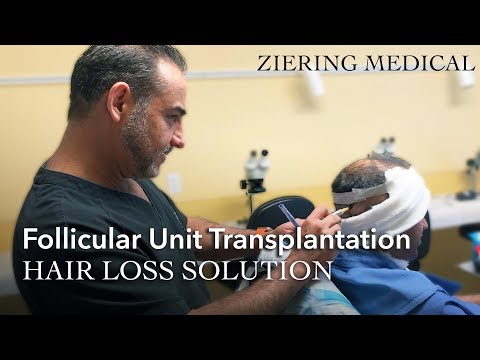 Follicular Unit Transplantation | FUT Hair Restoration...