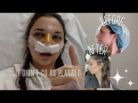 I got a nose job *in secret* and vlogged the process