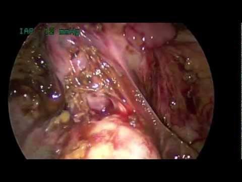 Podwójny- laparoskopowy oraz histeroskopowy dostęp do niekomunikującego rogu w macicy z przegrodą
