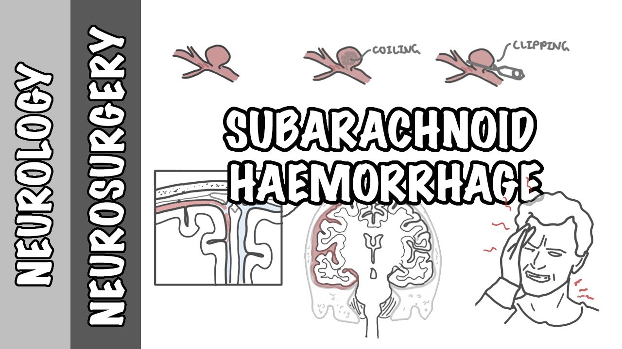 Subarachnoid Haemorrhage / pathophysiology, complications and management