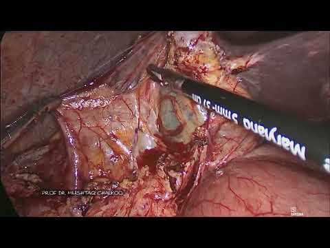 laparoscopic D 3  Right Hemicolectomy with omentectomy