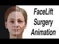 FaceLift Surgery Animation