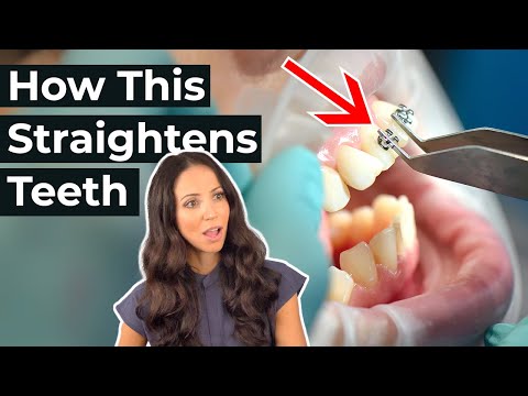 How Braces ACTUALLY Work