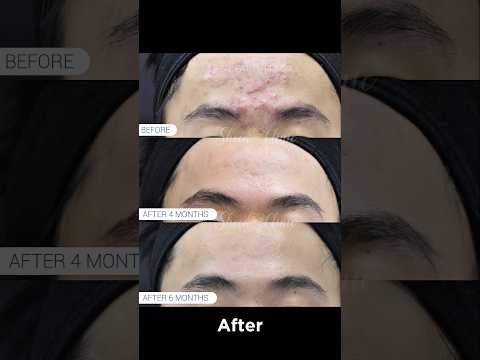 Can Acne Scars Be Improved? Real Patient Transformation