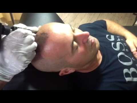 MSP ( Micro Scalp Pigmentation ) hair loss treatment by Phuket Hair Clinic