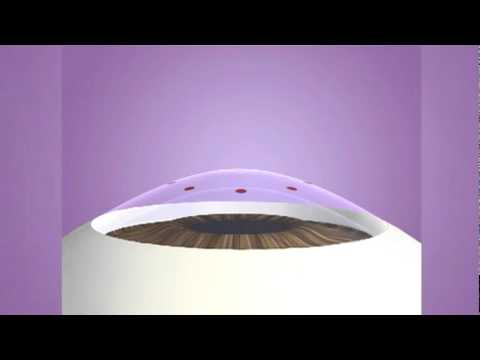 Laser Thermal Keratoplasty (LTK)