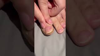 Toe Align Ingrown Nail Corrector Stickers( # 2609  ) 1️⃣ Product Link in Bio