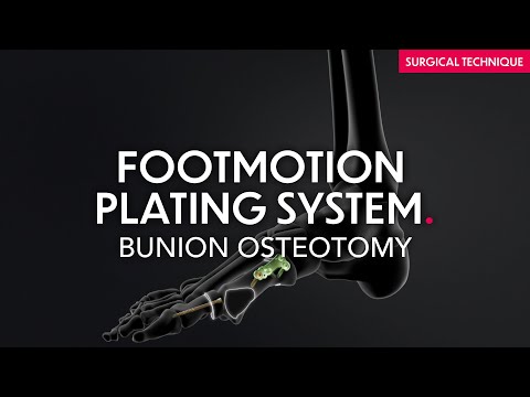 Surgical Technique - Mini Invasive Bunion Osteotomy - Footmotion Plating System