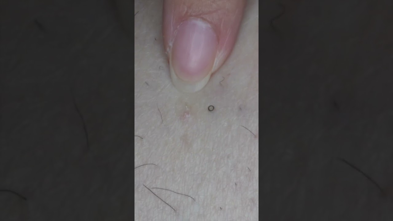 082 Buried, pushed, curled  #tweezers #毛抜き#shorts