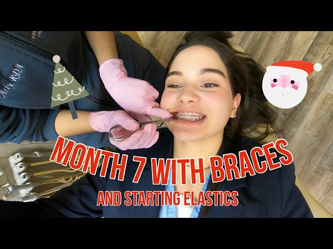 Braces Update 7 🦷 (Getting elastics on!)