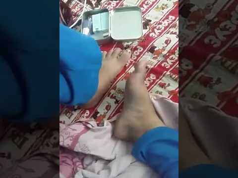 อาการโรคสะเก็ดเงินในผู้หญิง รอยแผลเป็นจาก neurodermatitis