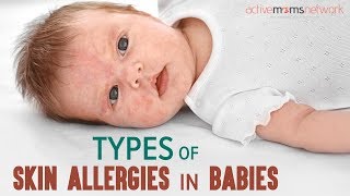 Types Of Skin Allergies In Babies | ActiveMomsNetwork