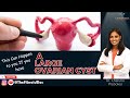 This Can Happen to you If you have A Large Ovarian Cyst - TheFibroidDoc - Dr. Cheruba Prabakar