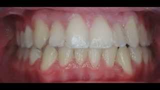preview picture of video 'Gorton & Schmohl Orthodontics - Orthodontic Morph Video J'