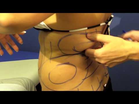 Nowak Ultimate Laser Body Contouring and Skin Tightening Procedure