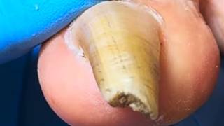 Extremely Long, Twisted Toenails With Onychomycosis, Completely And Thoroughly Trimmed【Xue Yidao】