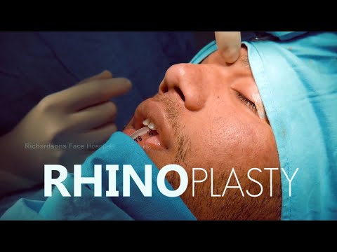 A Complete Nose Job Experience!