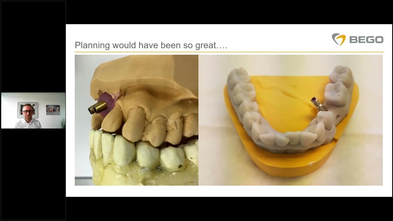 BEGO Implant Systems – Guided Surgery with BEGO Guide From theory into daily practice