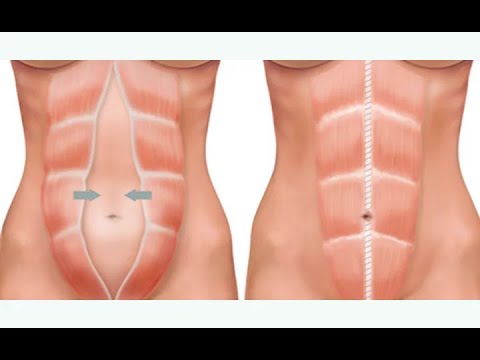 Diastasi dei muscoli retti dell'addome - Ecografia "gold standard"