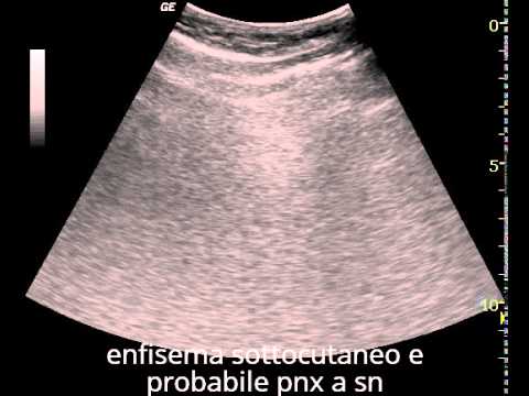 Se leva cade fuori di sesto Dolore osteocondrosi sotto le costole
