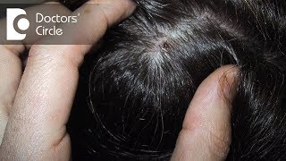How can one manage scabs on scalp with itching, white flakes &amp; dryness? - Dr. Rashmi Ravindra
