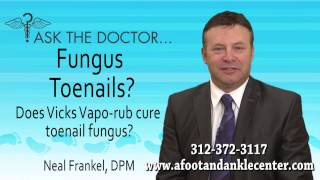 preview picture of video 'Does Vicks VapoRub Cure Toenail Fungus? Chicago, Lincolnwood, Oak Brook, IL - Podiatrist'
