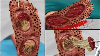 ASMR Treatment Removal Of Maggots Infected Foot | ASMR Cleaning Animation
