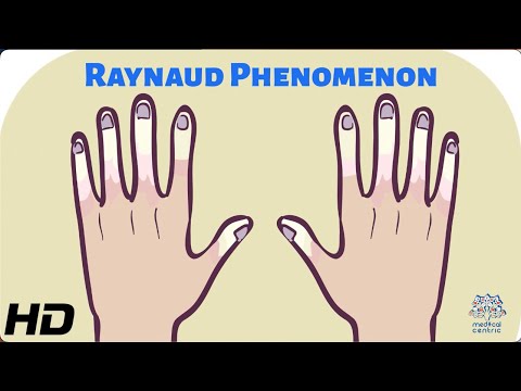 Blue Fingers and Toes: Understanding Raynaud Phenomenon
