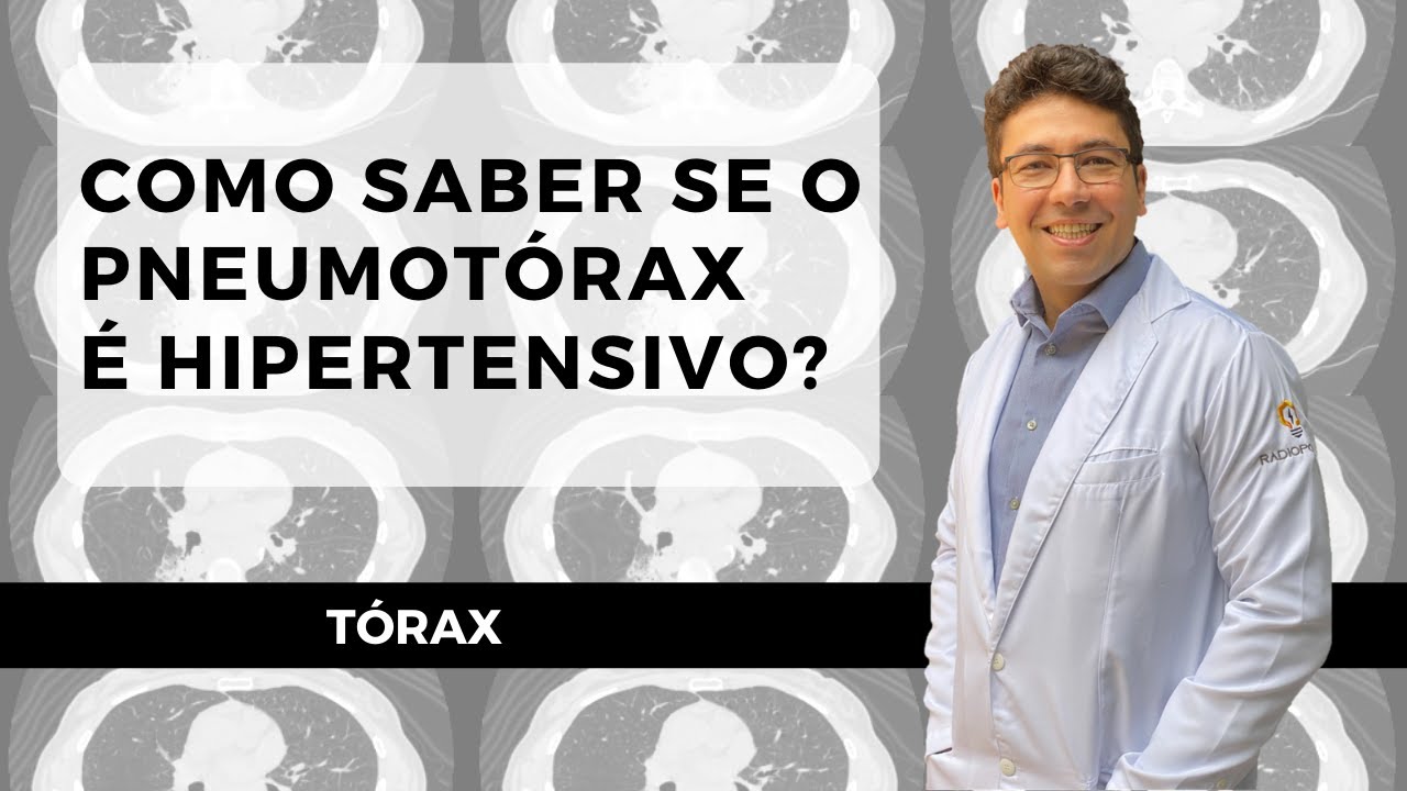 PNEUMOTÓRAX HIPERTENSIVO
