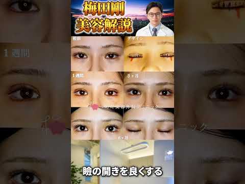 医学科 全体的に目を大きくする手術│眼瞼下垂