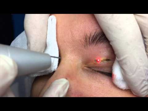 comment traiter xanthelasma