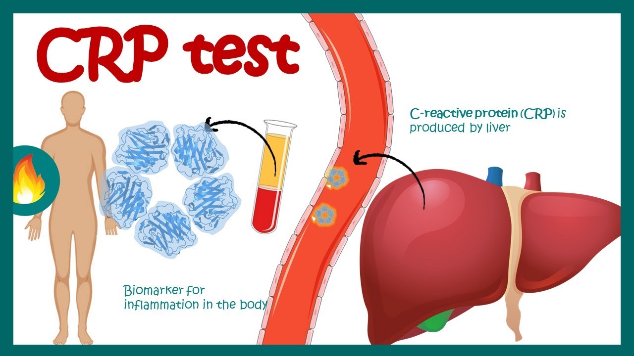 C-Reactive Protein (CRP) | Inflammation | Acute phase reactant | How do you read CRP test results