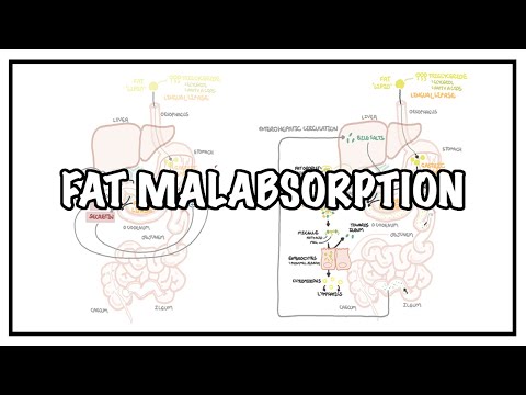 Approach to Fat malabsorption signs and symptoms and causes