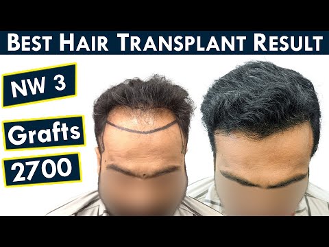 Grade 3 Baldness Results - 2700 Grafts || Best Hair Transplant Result Ahmedabad || HFHG Clinic