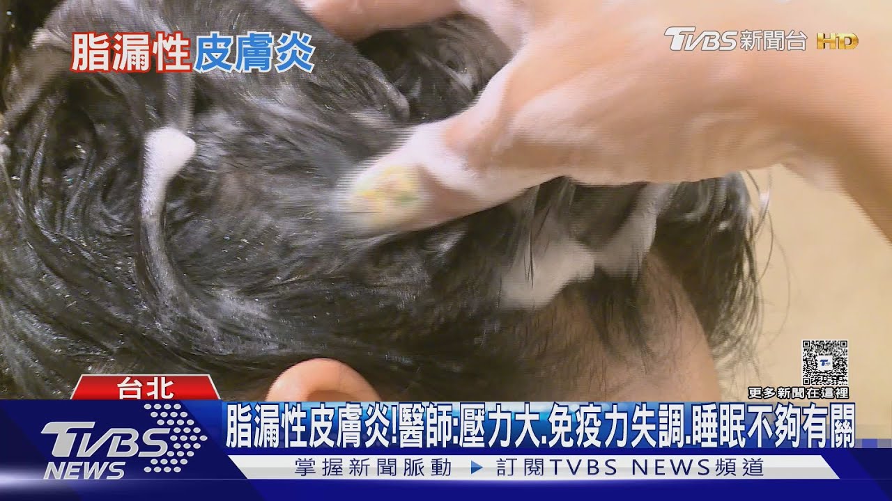 脂漏性皮膚炎!博士生熬夜頭皮掉屑超過十年 醫師:「這治療」救了他!