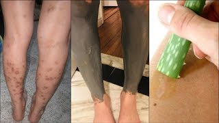 Bentonite Clay & Aloe Vera Treatment | Get Rid Of Dark Marks & Scars on Legs