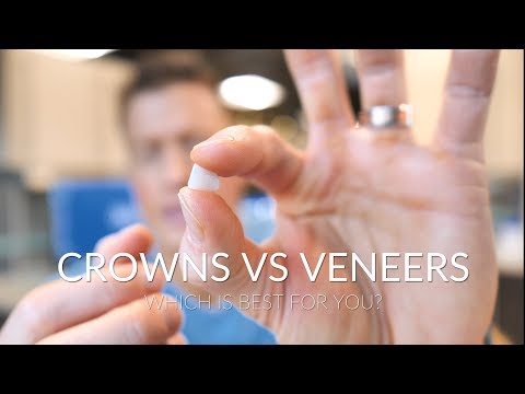 Crowns vs veneers - which is best?