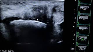 Epicondilitis- Tendinosis y Rotura Parcial