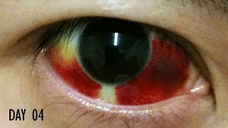 27 Days Healing Time Lapse: Broken Blood Vessel in Eye (Subconjunctival Hemorrhage)