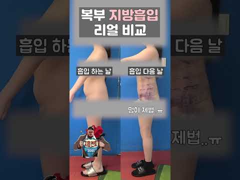 , title : '복부 지방흡입 전후 리얼 영상 #지방흡입'