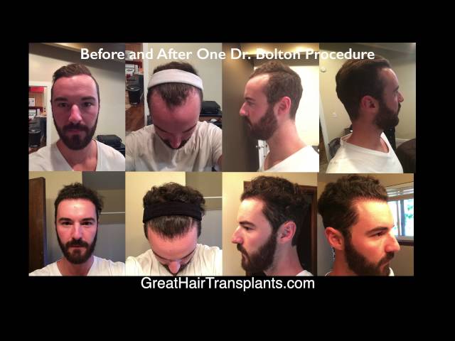 
Dr. Brett Bolton FUE / Robotic Correction Patient Casey Short Testimonial

