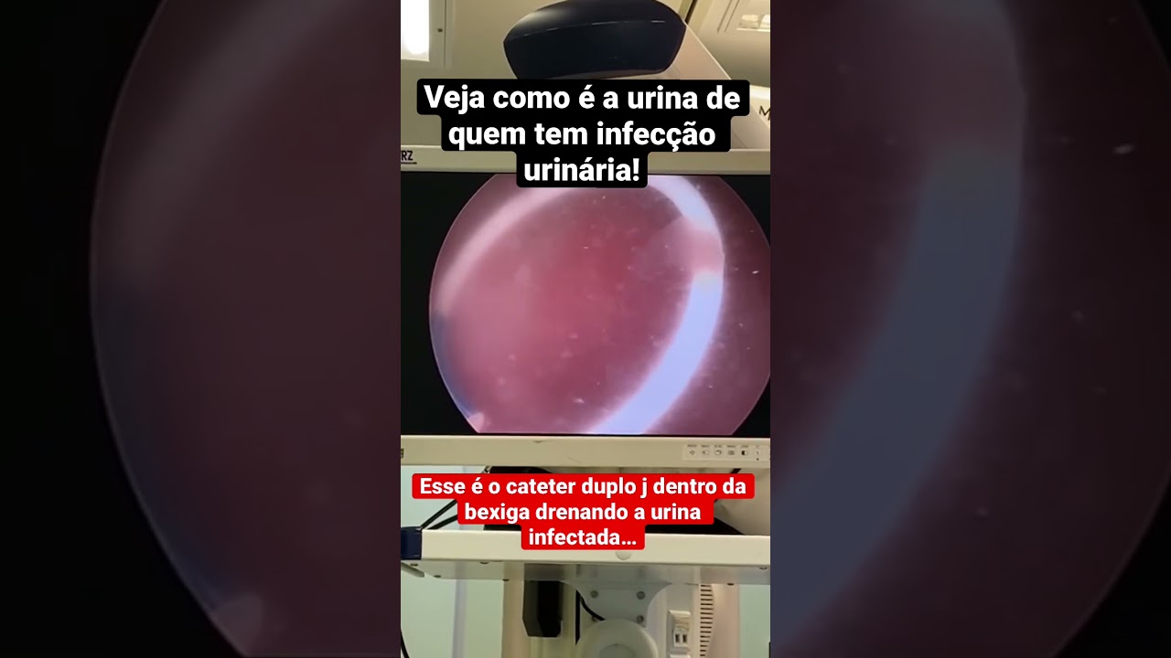 Veja como é a urina de quem tem infecção urinária! 🤒 #shorts