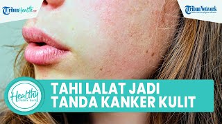 Hati-hati Tahi Lalat di Tubuh Bisa Jadi Tanda Kanker Kulit, Begini Cara Deteksi Sejak Dini