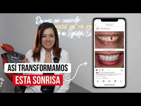 Como recuperar un diente de adelante 🤩