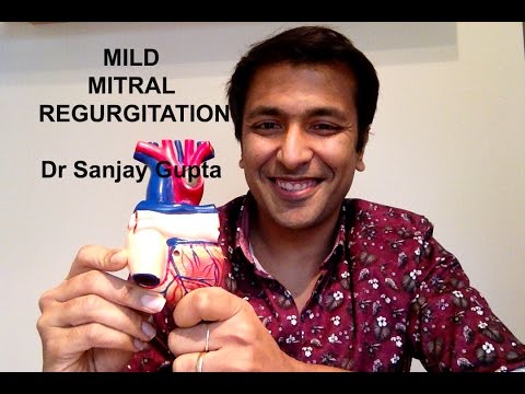 Mild mitral regurgitation
