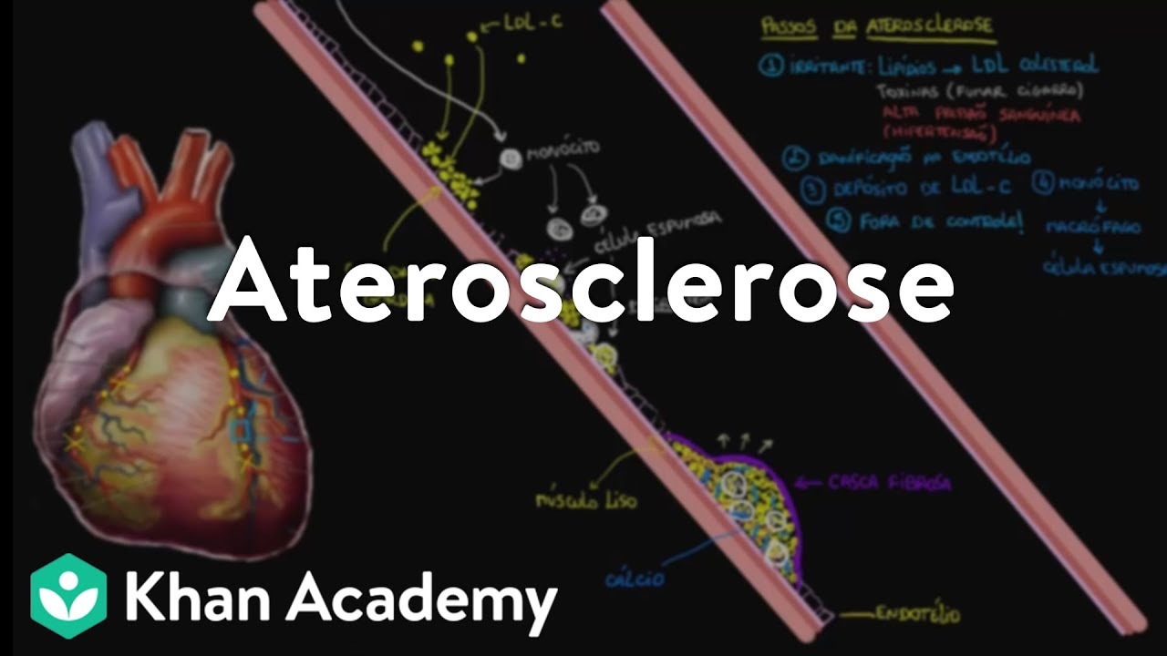 Aterosclerose