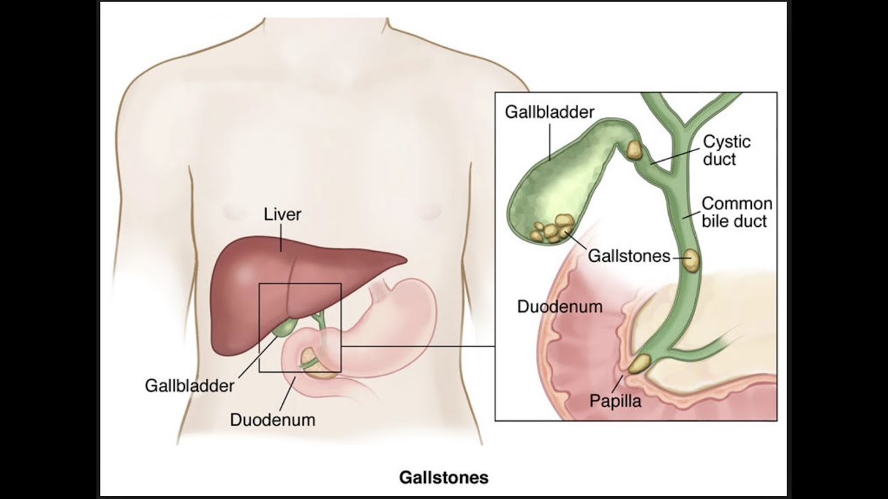 Choledocholithiasis: Common Bile Duct Stones: How to Treat them? - YouTube