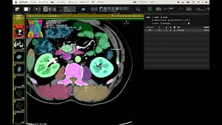 TotalSegmentator plugin for OsiriX (testing pre-lease version)