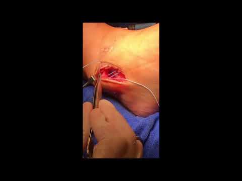 How Long Until You Can Walk Normally After a Bone Graft Surgery ASK DR MOORE